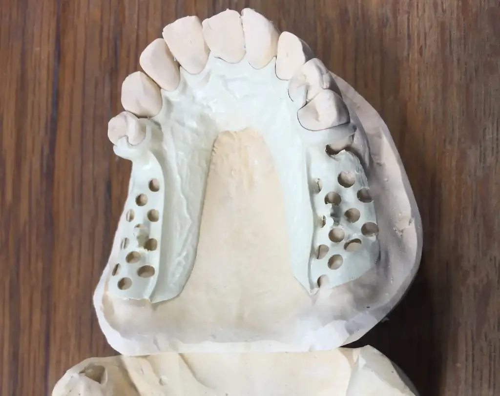 Prothèse dentaire en PEEK Carcassonne : la prothèses dentaire Bio HPP (PEEK) innovante