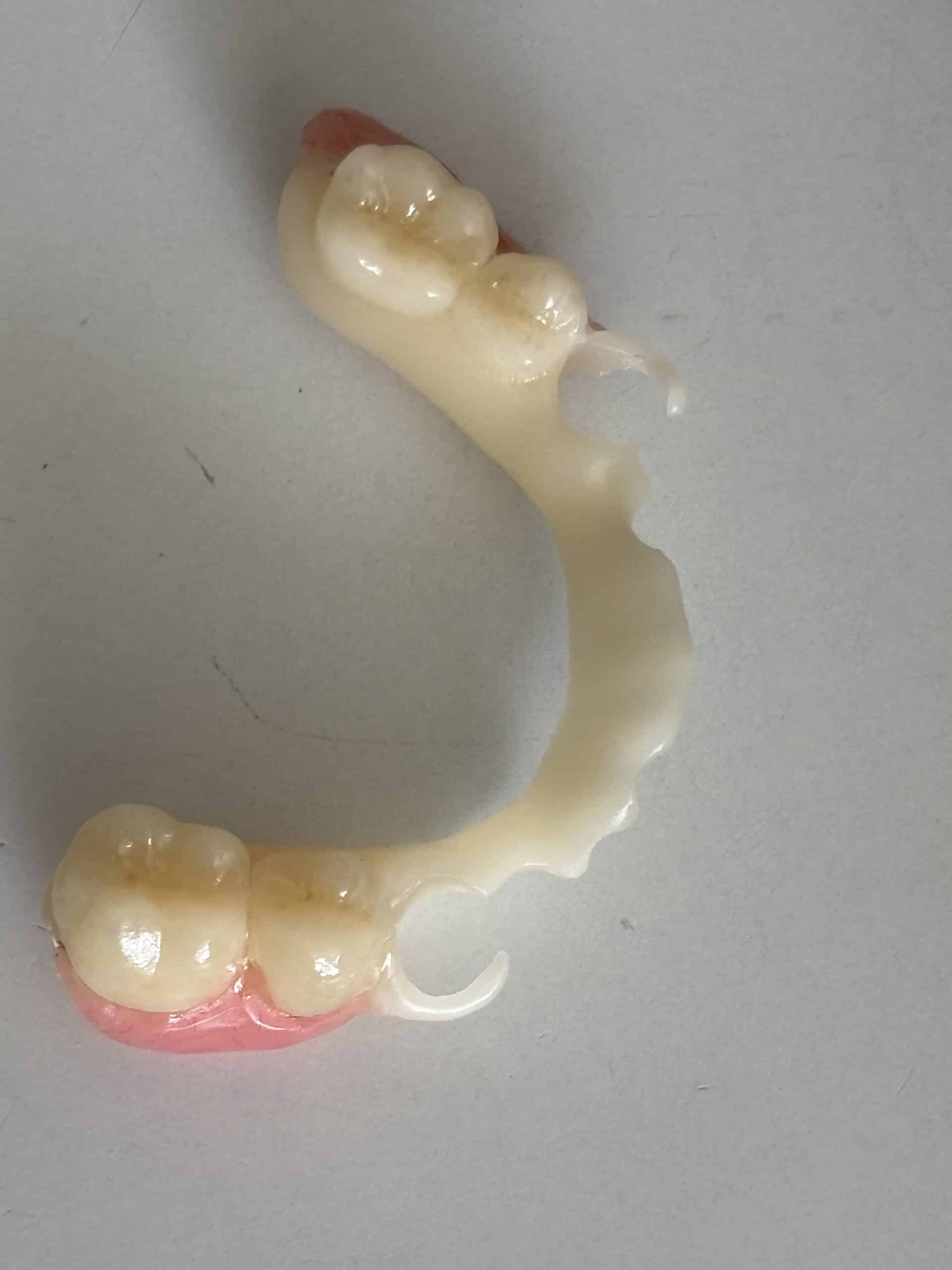 Prothèse dentaire partielle flexible en résine rose et beige avec quatre molaires artificielles.