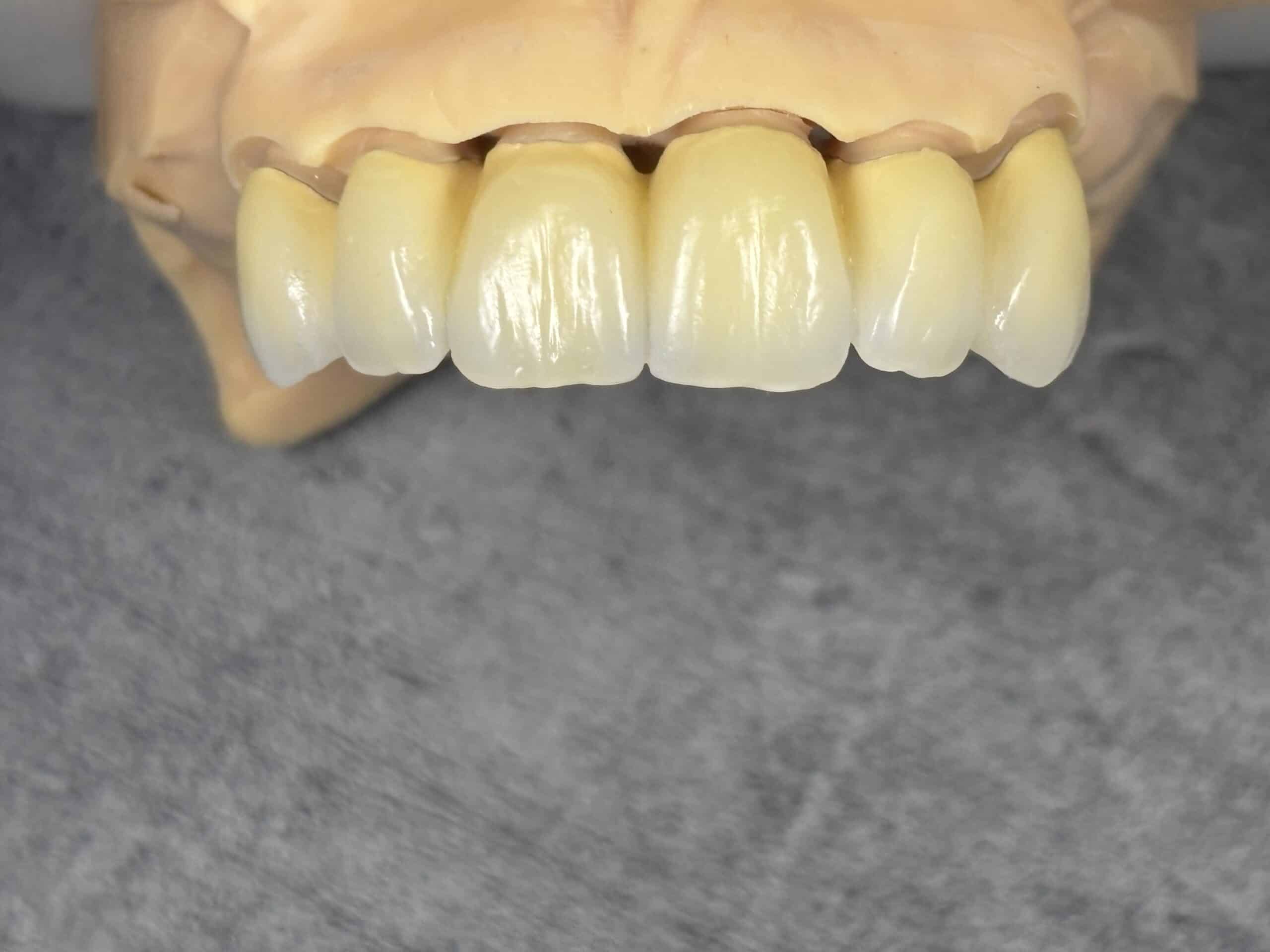 Six facettes dentaires en céramique translucide sur modèle en plâtre pour une restauration esthétique.