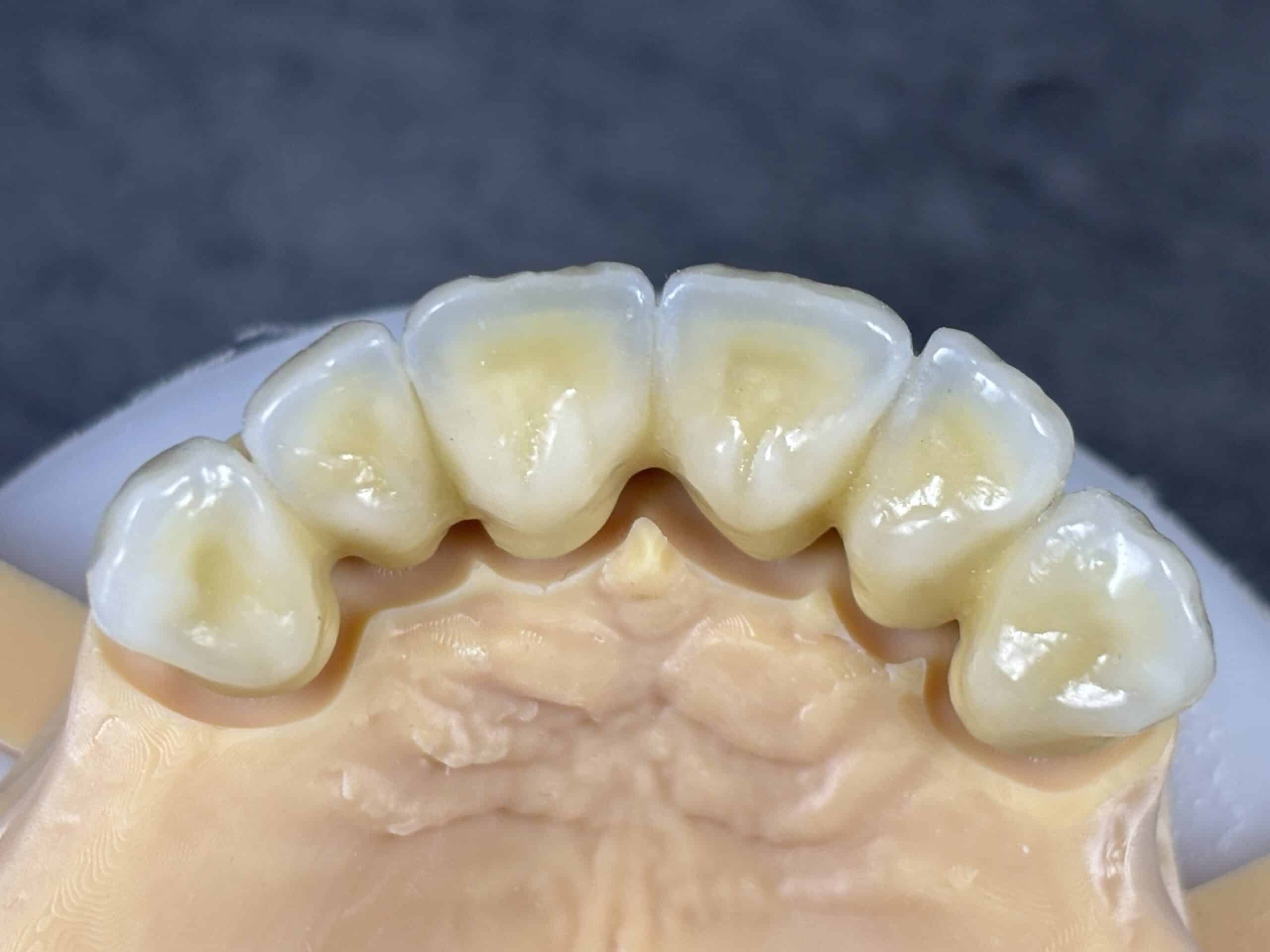 Couronnes céramiques sur modèle 3D dentaire, vue linguale des dents antérieures supérieures.