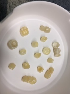 Prothèses dentaires en zircone à Carcassonne