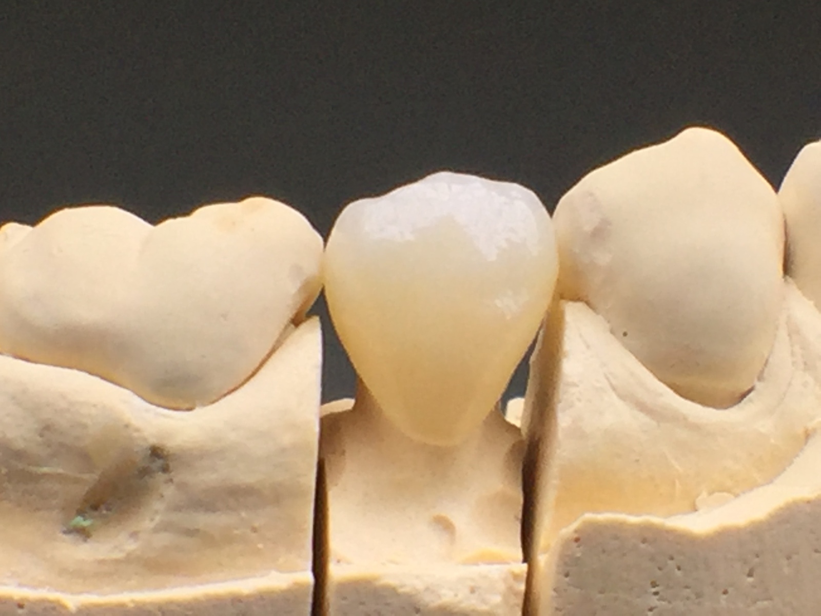 Laboratoire de prothèses dentaires en zircone à Carcassonne