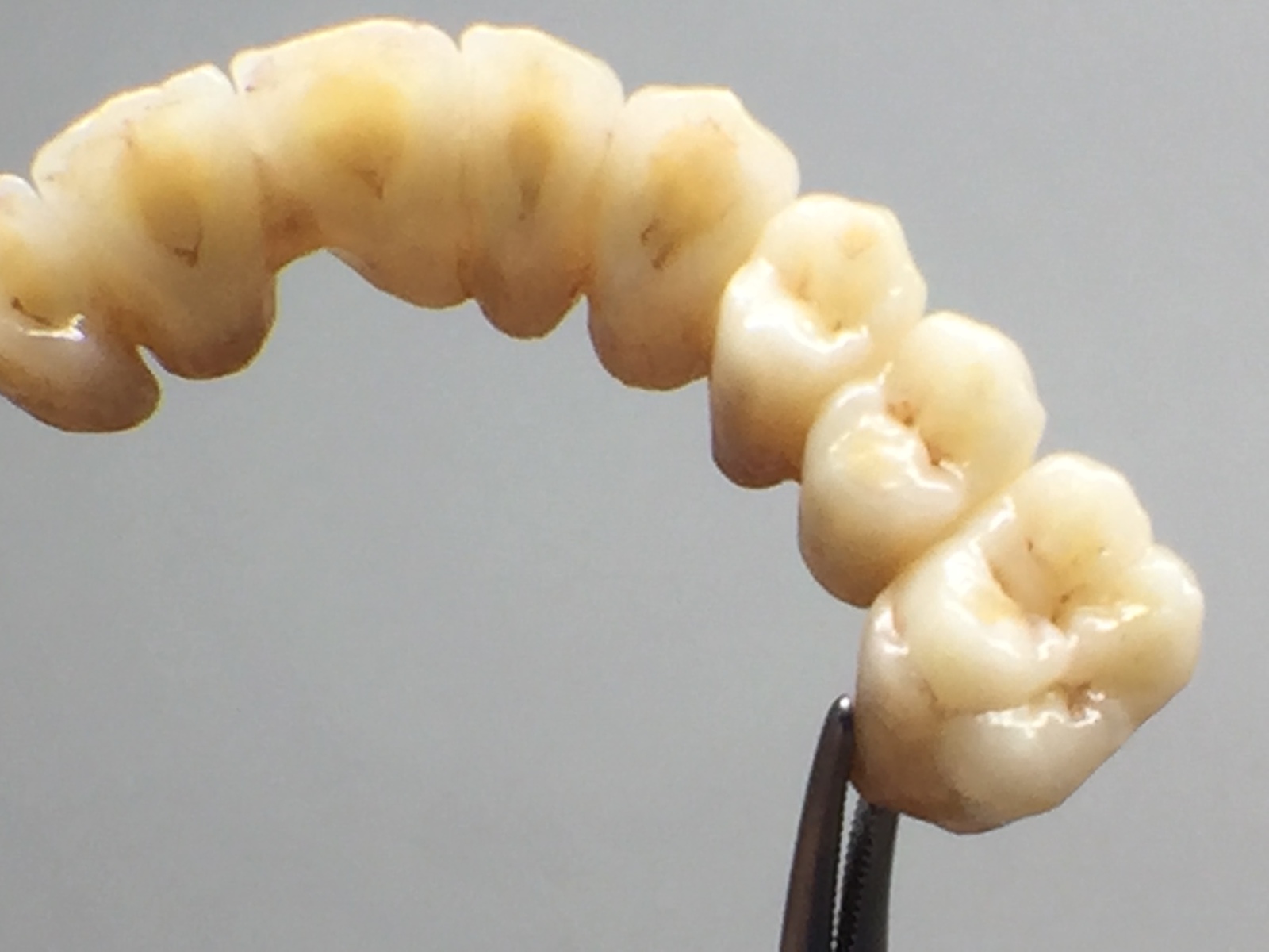 Laboratoire de prothèses dentaires en zircone à Carcassonne