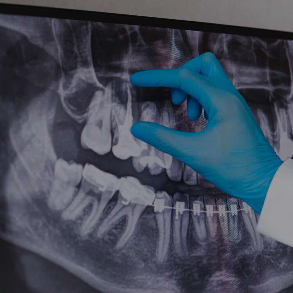 Radiographie dentaire et bagues : diagnostic orthodontique Dentiste ganté analysant une radiographie dentaire panoramique montrant des dents avec bagues orthodontiques.